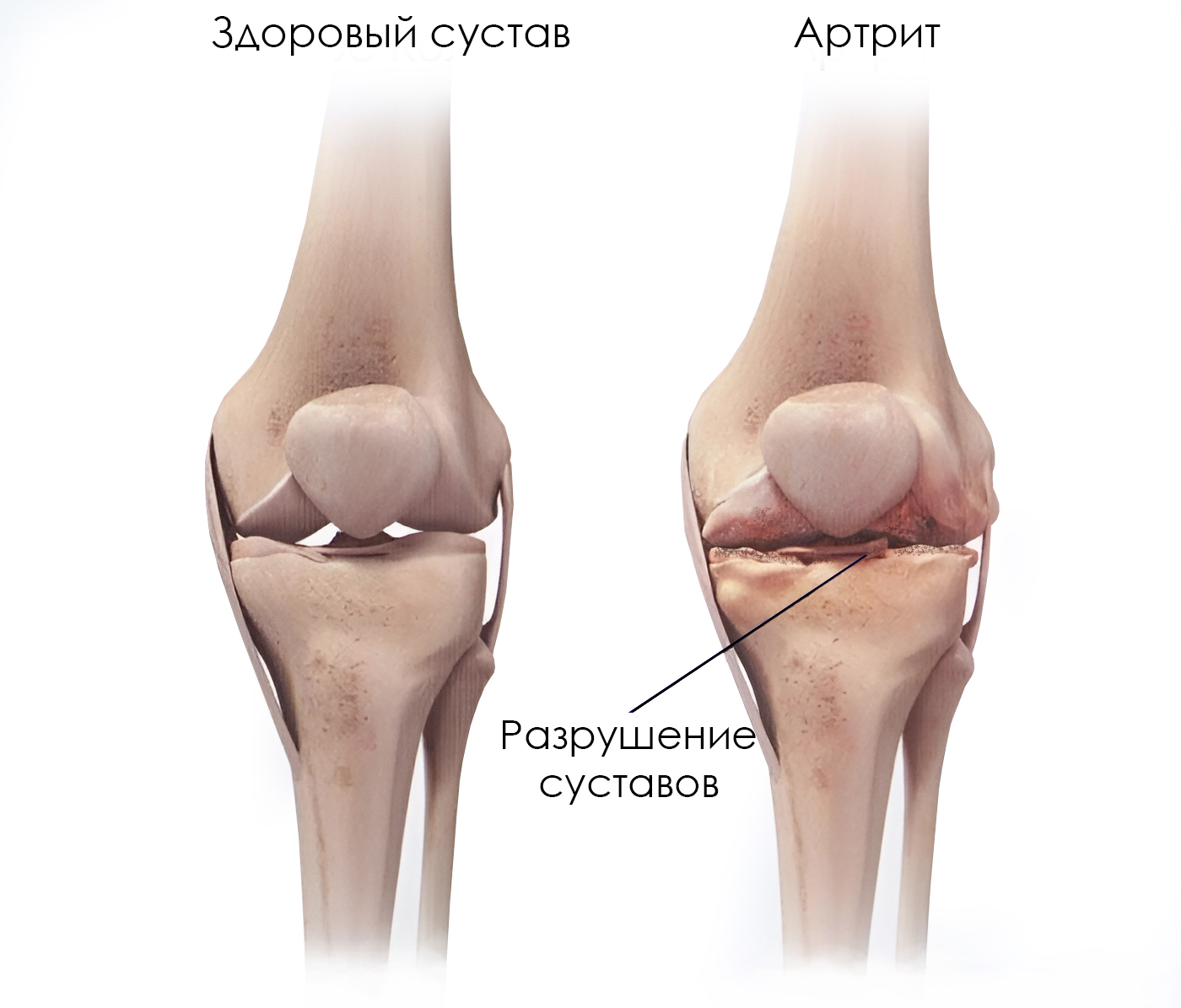 Артрит сустава что делать. Ревматоидный артрит коленного сустава. Ревматоидные артрит суставов колени. Ревматоидный артрит rjktyjh. Подагра коленного сустава рентген.